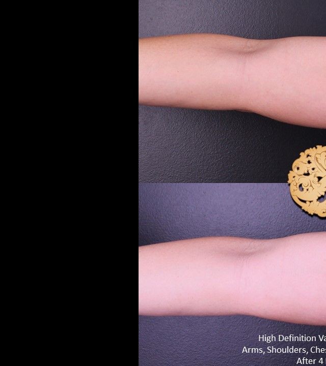 Liposuction before and after - before