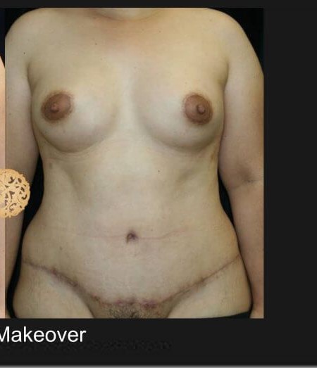 Mommy Makeover before and after - after