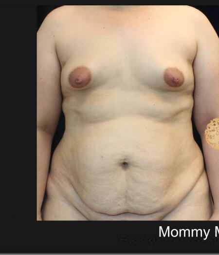 Mommy Makeover before and after - before
