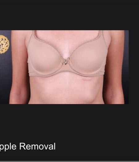 Accessory Nipple Removal before and after - after