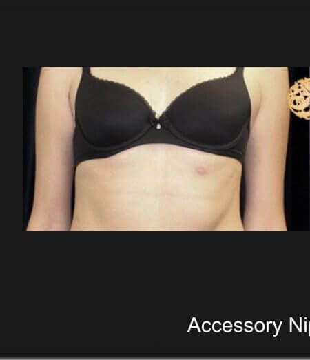 Accessory Nipple Removal before and after - before
