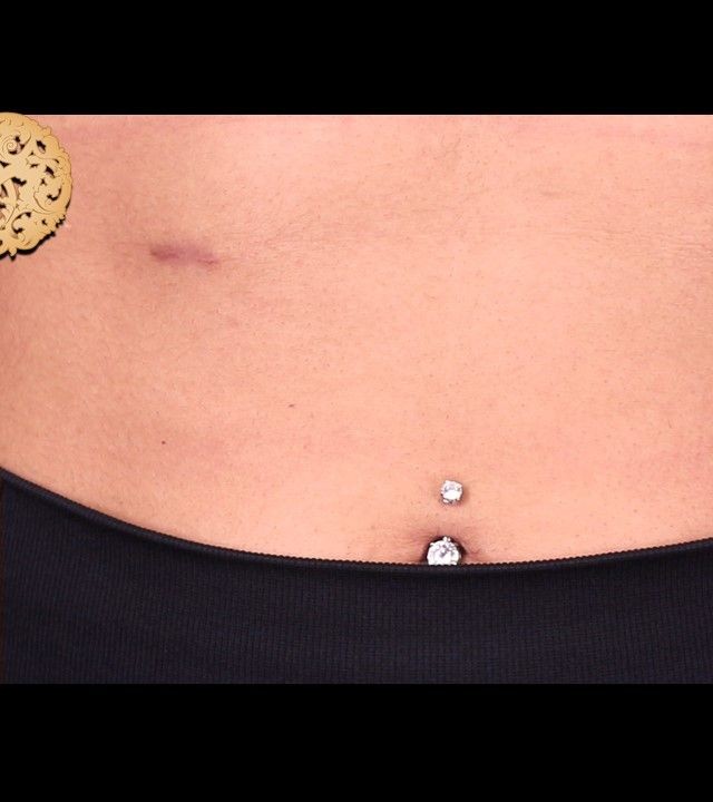 Accessory Nipple Removal before and after - after