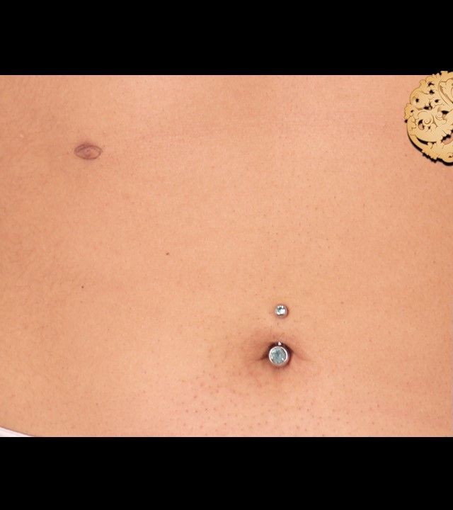 Accessory Nipple Removal before and after - before