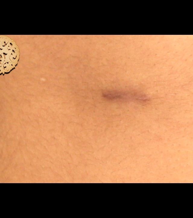 Accessory Nipple Removal before and after - after