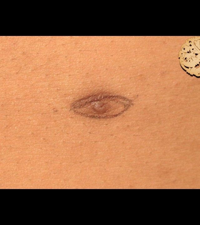 Accessory Nipple Removal before and after - before