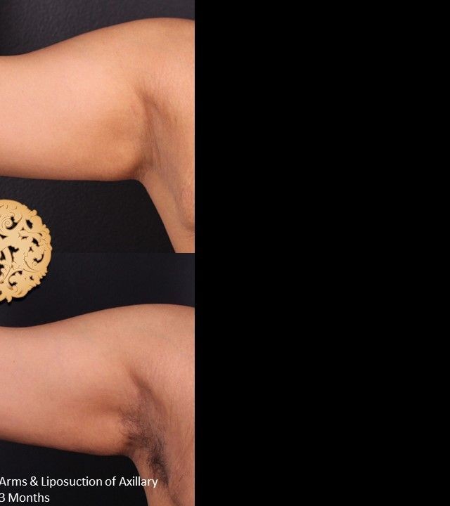 Liposuction before and after - after