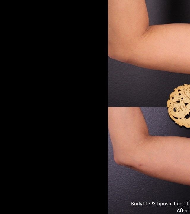 Liposuction before and after - before