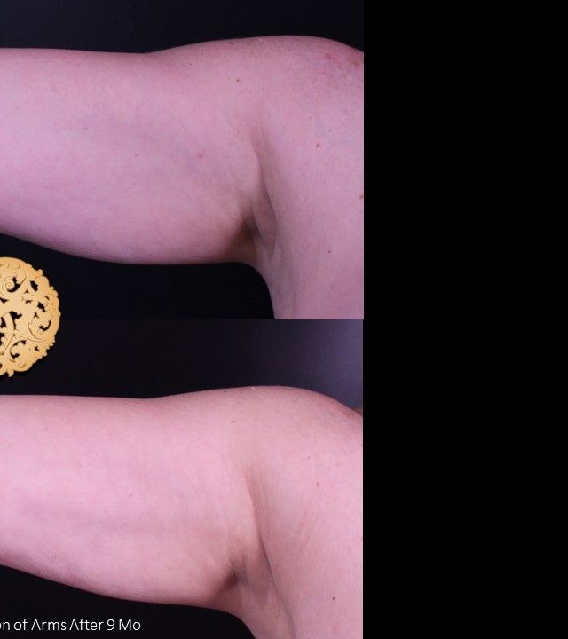 Liposuction before and after - after