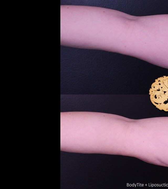 Liposuction before and after - before