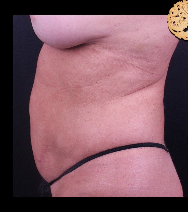 Mini Tummy Tuck before and after - before