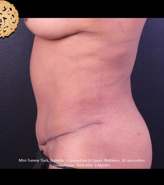Mini Tummy Tuck before and after - after