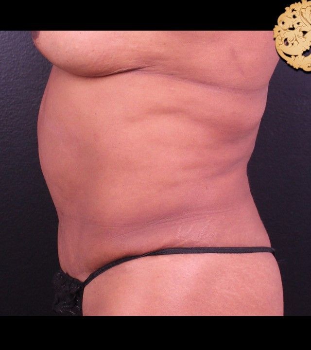 Mini Tummy Tuck before and after - before