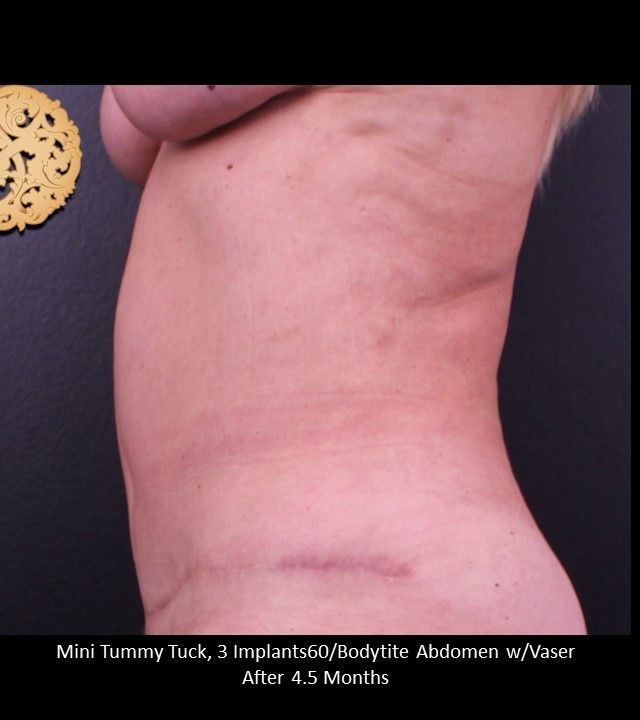 Mini Tummy Tuck before and after - after