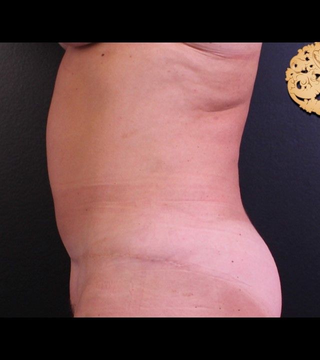 Mini Tummy Tuck before and after - before