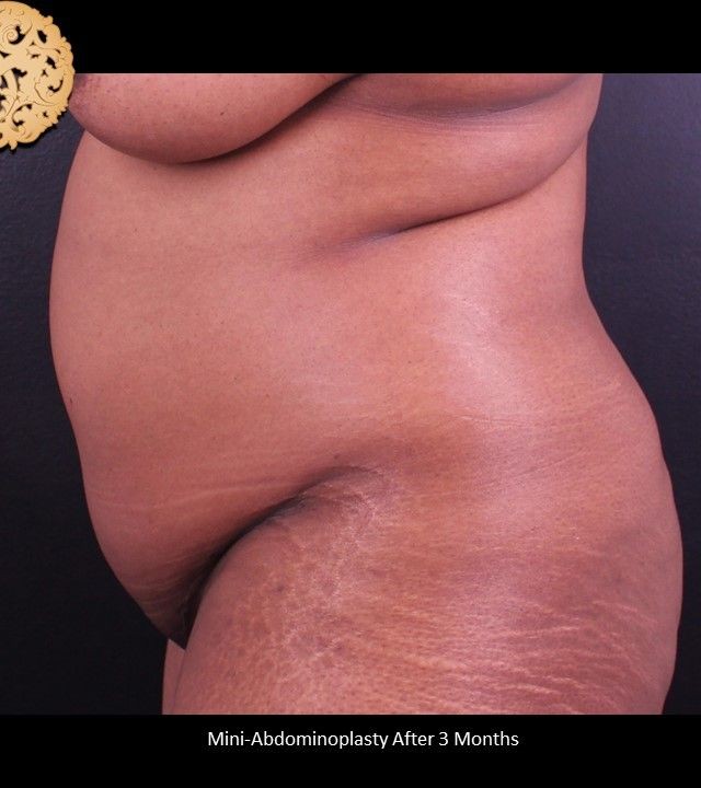 Mini Tummy Tuck before and after - after
