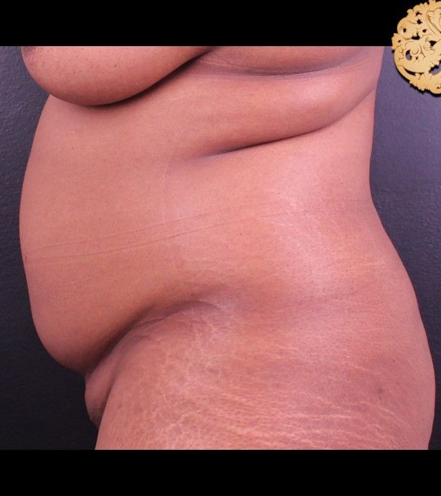 Mini Tummy Tuck before and after - before