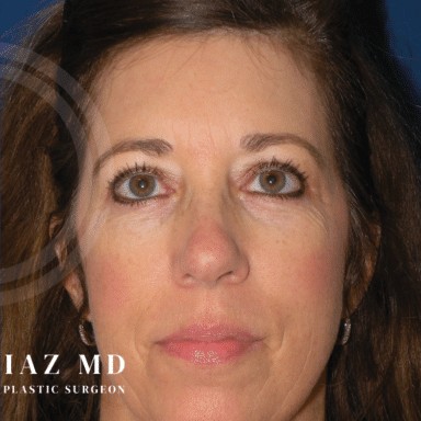Blepharoplasty before and after - after