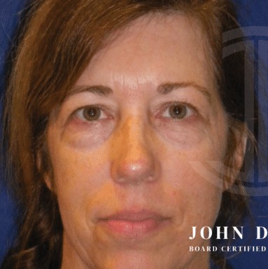 Blepharoplasty before and after - before