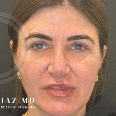 Blepharoplasty before and after - after