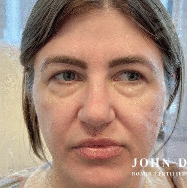 Blepharoplasty before and after - before
