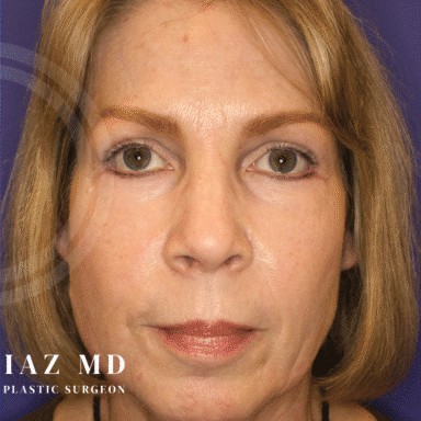 Blepharoplasty before and after - after