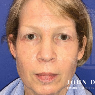 Blepharoplasty before and after - before