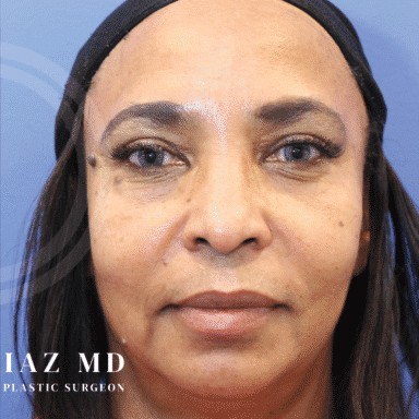 Blepharoplasty before and after - after