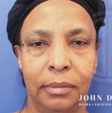 Blepharoplasty before and after - before