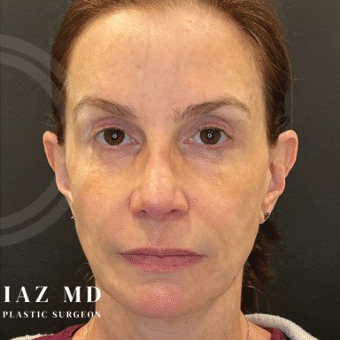 Blepharoplasty before and after - after