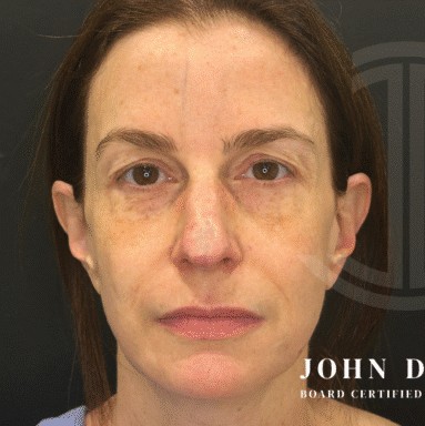 Blepharoplasty before and after - before