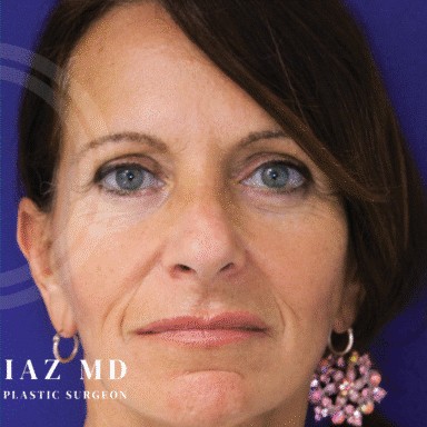 Blepharoplasty before and after - after
