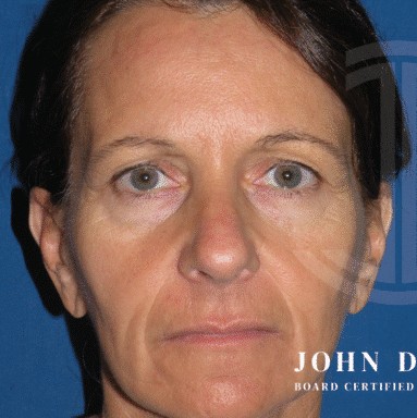 Blepharoplasty before and after - before