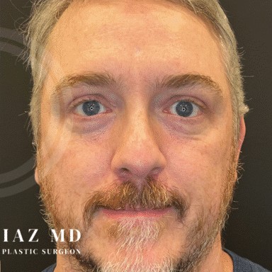 Blepharoplasty before and after - after