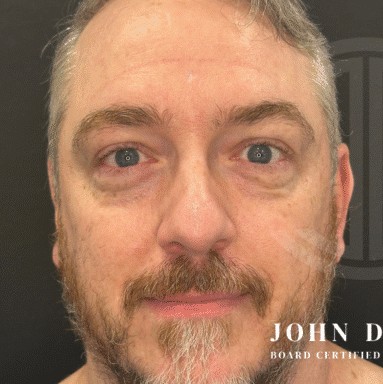 Blepharoplasty before and after - before