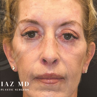 Blepharoplasty before and after - after