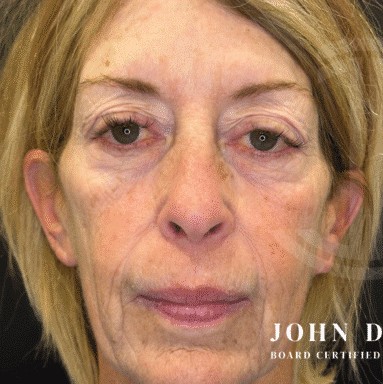 Blepharoplasty before and after - before