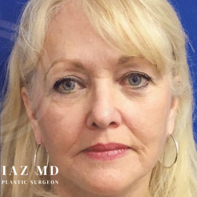 Blepharoplasty before and after - after