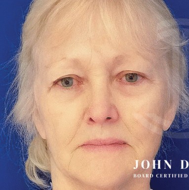 Blepharoplasty before and after - before