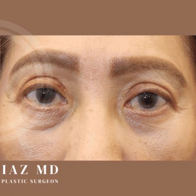Blepharoplasty before and after - after