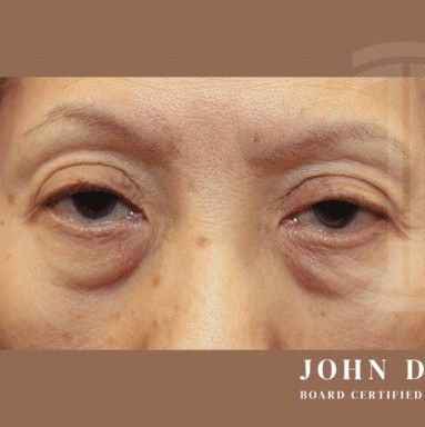 Blepharoplasty before and after - before