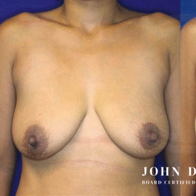 Breast Augmentation with Breast Lift before and after - before