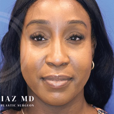 Blepharoplasty before and after - after