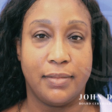 Blepharoplasty before and after - before