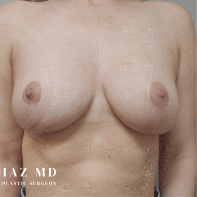 Breast Augmentation with Breast Lift before and after - after
