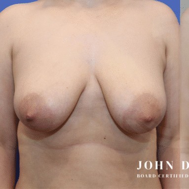 Breast Augmentation with Breast Lift before and after - before