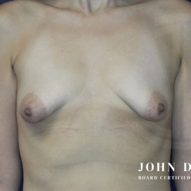 Breast Augmentation with Breast Lift before and after - before