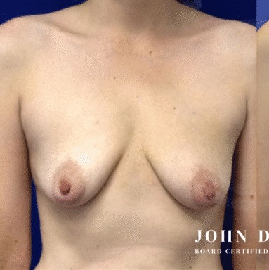 Breast Augmentation with Breast Lift before and after - before