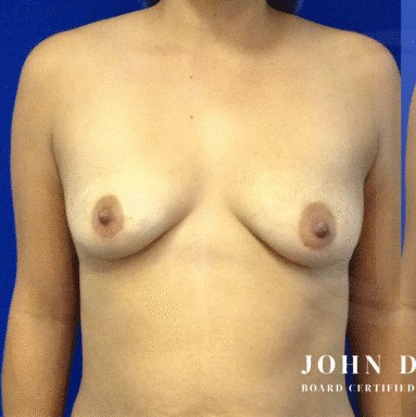 Breast Augmentation with Breast Lift before and after - before