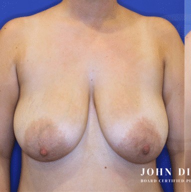 Breast Augmentation with Breast Lift before and after - before