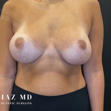 Breast Augmentation with Breast Lift before and after - after